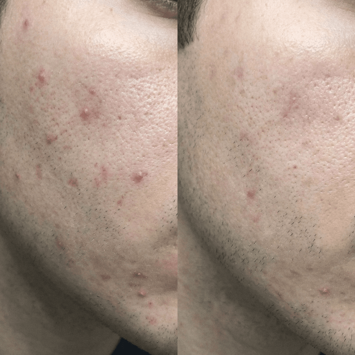 Κρέμα CBD Blemish Purity για επιρρεπές σε ακμή δέρμα